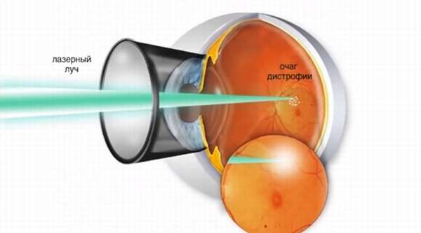 Гипертоническая ретинопатия: симптомы и лечение